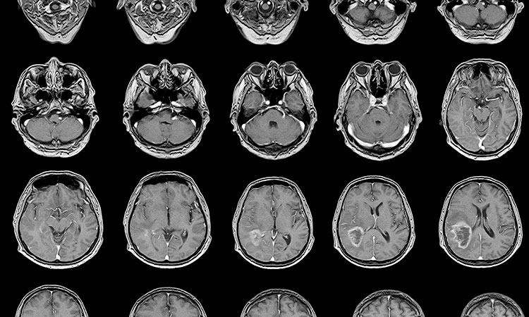 Isquemia Cerebral