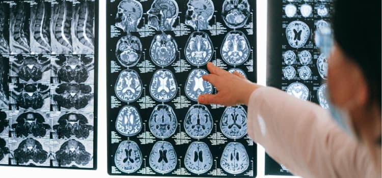 Desencadenantes de la isquemia cerebral